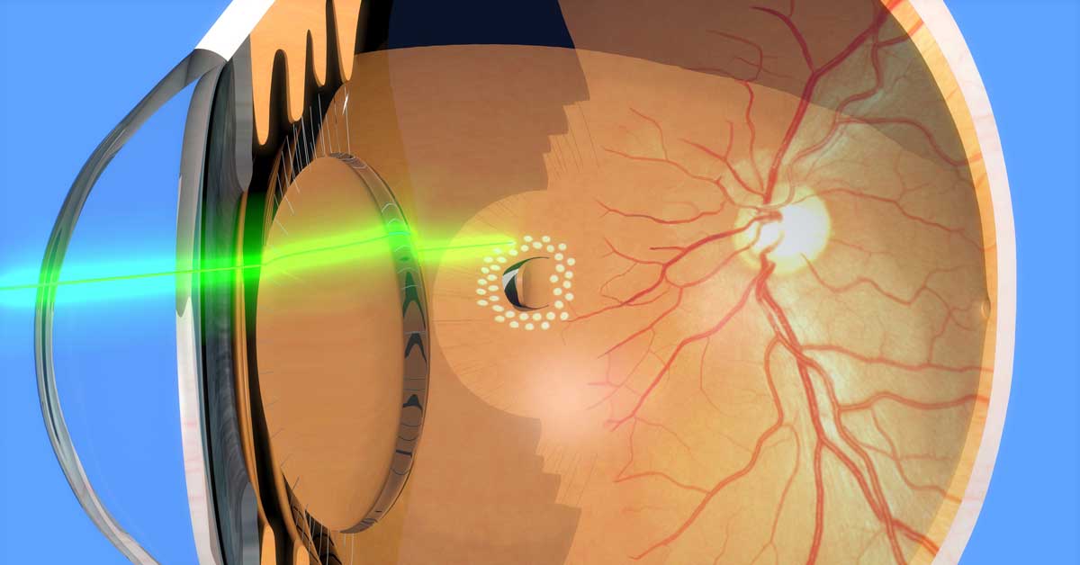 Argon lazer ile retina yırtığının lazerlenmesi